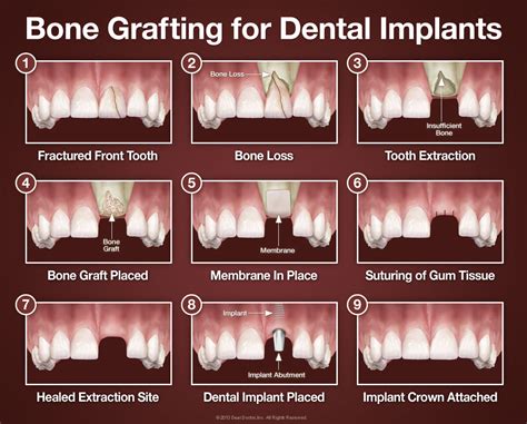  Ossobone: O Material Revolucionário para Implantes Ósseos de Alta Resistência!