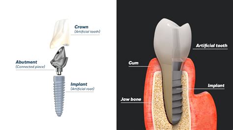 Xylitol: Uma Bioaventura para Próteses Dentárias e Implantes Ósseos!